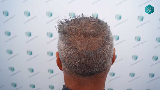Injerto Capilar Técnica FUE Grafts 3712 (7455 Pelos) 63 70 DISENO LINEA INJERTO