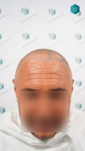 Injerto Capilar Técnica FUE Grafts 3712 (7455 Pelos) 64 71 DISENO LINEA INJERTO
