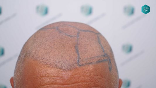 Injerto Capilar Técnica FUE Grafts 3712 (7455 Pelos) 65 72 DISENO LINEA INJERTO