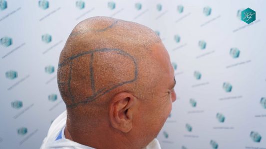 Injerto Capilar Técnica FUE Grafts 3712 (7455 Pelos) 66 72A DISENO LINEA INJERTO