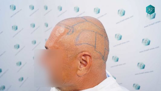 Injerto Capilar Técnica FUE Grafts 3712 (7455 Pelos) 67 73 DISENO LINEA INJERTO