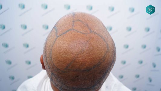 Injerto Capilar Técnica FUE Grafts 3712 (7455 Pelos) 68 75 DISENO LINEA INJERTO