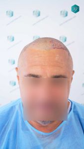Injerto Capilar Técnica FUE Grafts 3712 (7455 Pelos) 69 76 TRASPLANTE CAPILAR
