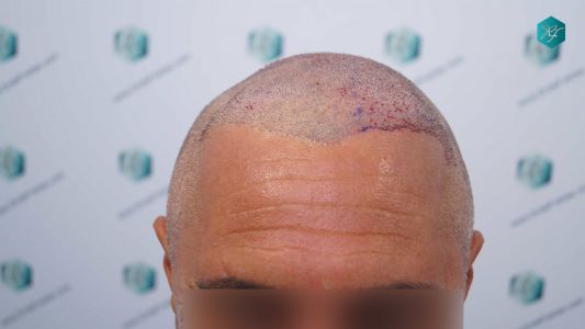 SEGUNDA INTERVENCIÓN TRASPLANTE 77 TRASPLANTE CAPILAR