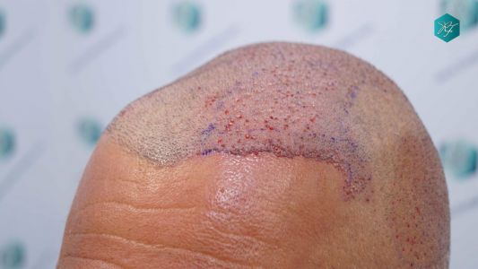 Injerto Capilar Técnica FUE Grafts 3712 (7455 Pelos) 70 78 TRASPLANTE CAPILAR