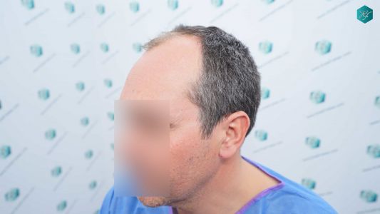 Injerto Capilar Técnica FUE Grafts 3289 (8464 Pelos) 5 8 ANTES DEL TRASPLANTE CAPILAR