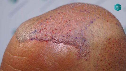 Injerto Capilar Técnica FUE Grafts 3712 (7455 Pelos) 72 80 TRASPLANTE CAPILAR