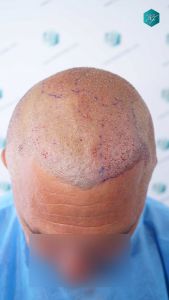 Injerto Capilar Técnica FUE Grafts 3712 (7455 Pelos) 73 81 TRASPLANTE CAPILAR