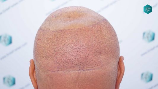 Injerto Capilar Técnica FUE Grafts 3712 (7455 Pelos) 75 83 TRASPLANTE CAPILAR