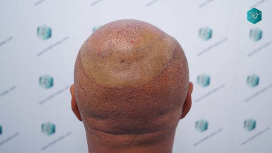Injerto Capilar Técnica FUE Grafts 3712 (7455 Pelos) 76 84 TRASPLANTE CAPILAR