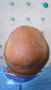 Injerto Capilar Técnica FUE Grafts 3712 (7455 Pelos) 77 85 TRASPLANTE CAPILAR