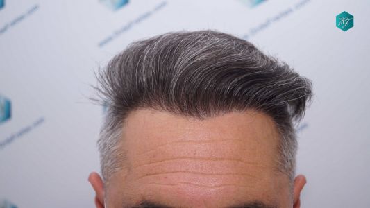 Injerto Capilar Técnica FUE Grafts 3712 (7455 Pelos) 78 88 RESULTADOS A LOS 12 MESES
