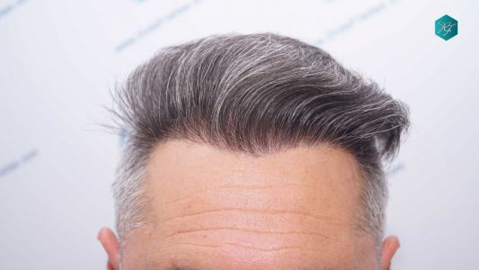 Injerto Capilar Técnica FUE Grafts 3712 (7455 Pelos) 79 89 RESULTADOS A LOS 12 MESES