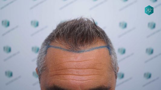 Injerto Capilar Técnica FUE Grafts 3712 (7455 Pelos) 7 9 DISENO LINEA DE INJERTO