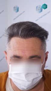Injerto Capilar Técnica FUE Grafts 3712 (7455 Pelos) 80 90 RESULTADOS A LOS 12 MESES
