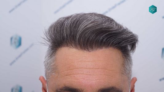Injerto Capilar Técnica FUE Grafts 3712 (7455 Pelos) 81 91 RESULTADOS A LOS 12 MESES