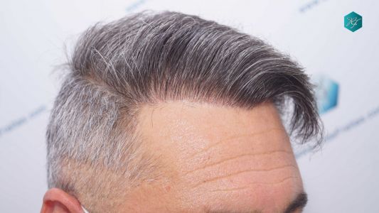 Injerto Capilar Técnica FUE Grafts 3712 (7455 Pelos) 82 92AB RESULTADOS A LOS 12 MESES