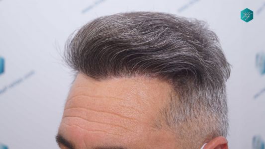 Injerto Capilar Técnica FUE Grafts 3712 (7455 Pelos) 84 93B RESULTADOS A LOS 12 MESES