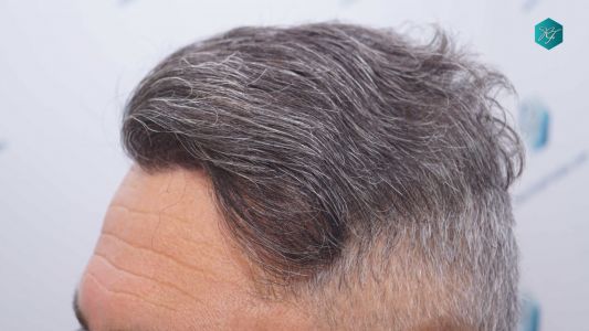 Injerto Capilar Técnica FUE Grafts 3712 (7455 Pelos) 85 96 RESULTADOS A LOS 12 MESES