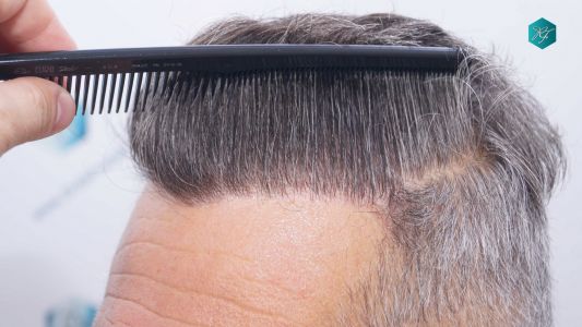 Injerto Capilar Técnica FUE Grafts 3712 (7455 Pelos) 86 97 RESULTADOS A LOS 12 MESES
