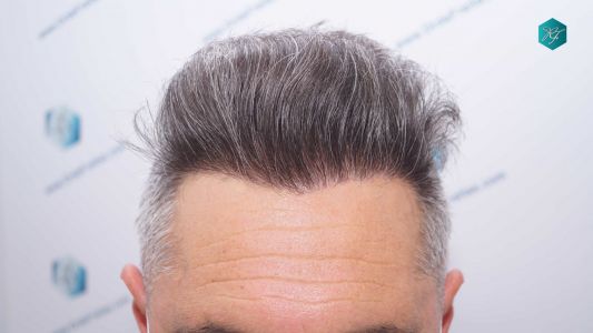 Injerto Capilar Técnica FUE Grafts 3712 (7455 Pelos) 87 98 RESULTADOS A LOS 12 MESES