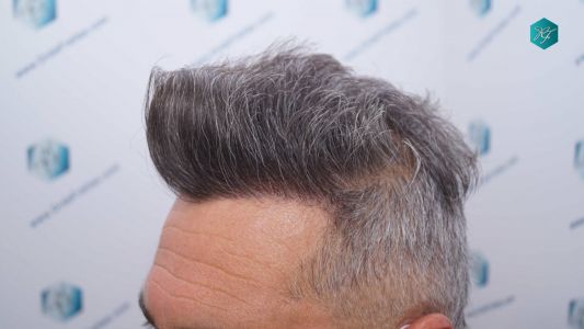 Injerto Capilar Técnica FUE Grafts 3712 (7455 Pelos) 88 98A RESULTADOS A LOS 12 MESES