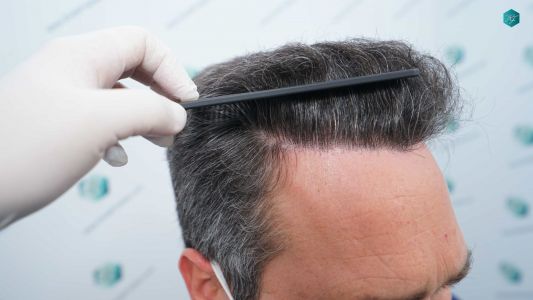 Injerto Capilar Técnica FUE Grafts 3289 (8464 Pelos) 27 99A 12 MESES EVOLUCION