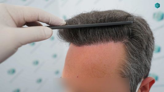 Injerto Capilar Técnica FUE Grafts 3289 (8464 Pelos) 28 99B 12 MESES EVOLUCION