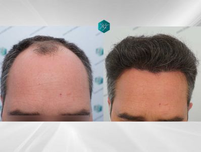 Injerto Capilar Técnica FUE Grafts 3289 (8464 Pelos) 39 X1 COMPARATIVA