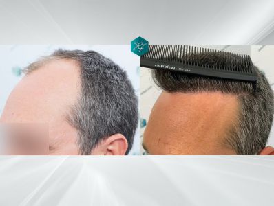 Injerto Capilar Técnica FUE Grafts 3289 (8464 Pelos) 40 X2 COMPARATIVA