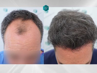 Injerto Capilar Técnica FUE Grafts 3289 (8464 Pelos) 41 X4 COMPARATIVA