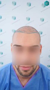 Injerto Capilar Técnica FUE Grafts 2006 (4905 Pelos) 11 11 DISENO LINEA DE INJERTO