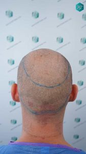 Injerto Capilar Técnica FUE Grafts 2006 (4905 Pelos) 13 13 DISENO LINEA DE INJERTO