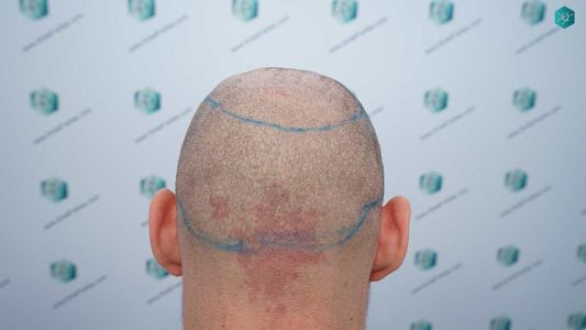 Injerto Capilar Técnica FUE Grafts 2006 (4905 Pelos) 16 14 DISENO LINEA DE INJERTO
