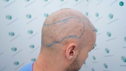 Injerto Capilar Técnica FUE Grafts 2006 (4905 Pelos) 14 15 DISENO LINEA DE INJERTO