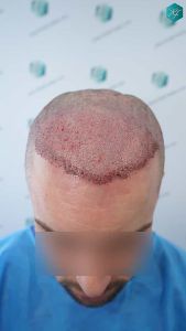 Injerto Capilar Técnica FUE Grafts 2006 (4905 Pelos) 17 18 TRASPLANTE CAPILAR