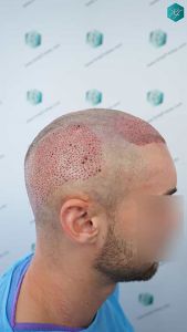 Injerto Capilar Técnica FUE Grafts 2006 (4905 Pelos) 20 19 TRASPLANTE CAPILAR