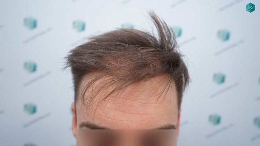 Injerto Capilar Técnica FUE Grafts 2006 (4905 Pelos) 1 2 ANTES DEL TRASPLANTE CAPILAR
