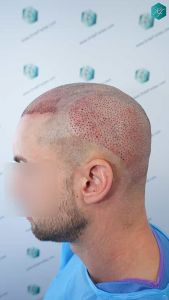 Injerto Capilar Técnica FUE Grafts 2006 (4905 Pelos) 21 20 TRASPLANTE CAPILAR