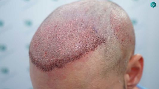 Injerto Capilar Técnica FUE Grafts 2006 (4905 Pelos) 19 20A TRASPLANTE CAPILAR