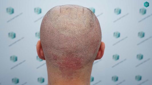 Injerto Capilar Técnica FUE Grafts 2006 (4905 Pelos) 23 22 TRASPLANTE CAPILAR