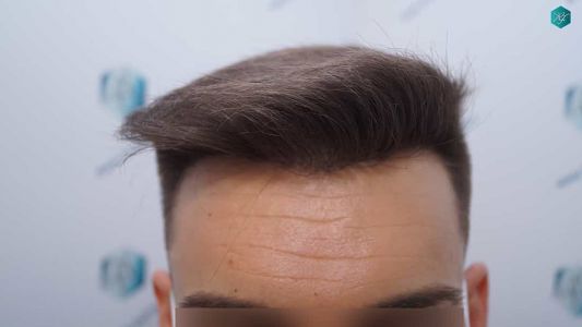 Injerto Capilar Técnica FUE Grafts 2006 (4905 Pelos) 29 24 RESULTADOS A LOS 12 MESES