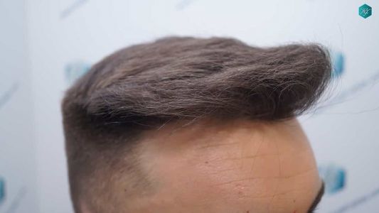 Injerto Capilar Técnica FUE Grafts 2006 (4905 Pelos) 30 26 RESULTADOS A LOS MESES