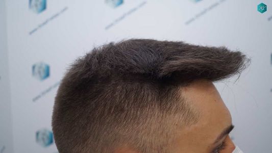 Injerto Capilar Técnica FUE Grafts 2006 (4905 Pelos) 32 28 RESULTADOS A LOS MESES