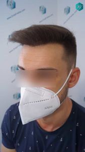 Injerto Capilar Técnica FUE Grafts 2006 (4905 Pelos) 28 29 RESULTADOS A LOS MESES
