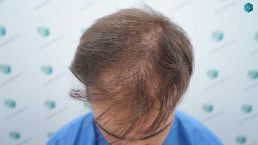 Injerto Capilar Técnica FUE Grafts 2006 (4905 Pelos) 2 3 ANTES DEL TRASPLANTE CAPILAR