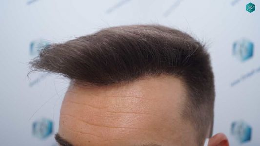 Injerto Capilar Técnica FUE Grafts 2006 (4905 Pelos) 31 30 RESULTADOS A LOS MESES