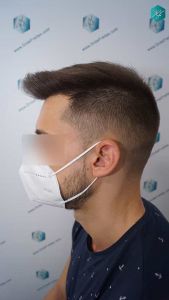 Injerto Capilar Técnica FUE Grafts 2006 (4905 Pelos) 26 31 RESULTADOS A LOS MESES