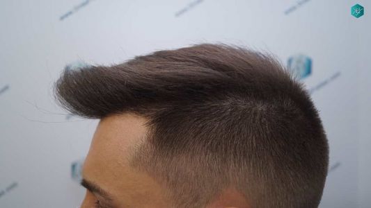 Injerto Capilar Técnica FUE Grafts 2006 (4905 Pelos) 33 32 RESULTADOS A LOS MESES