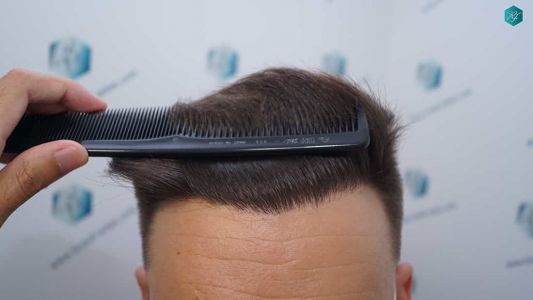 Injerto Capilar Técnica FUE Grafts 2006 (4905 Pelos) 36 34 RESULTADOS A LOS MESES